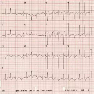 Brugada-type-1